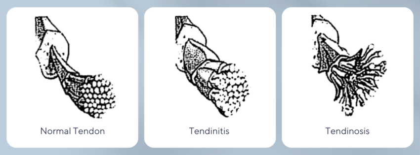 tendinitis versus tendinosis